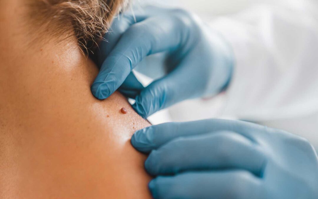 The Importance of Regular Skin Checks: Catching Skin Cancer Early